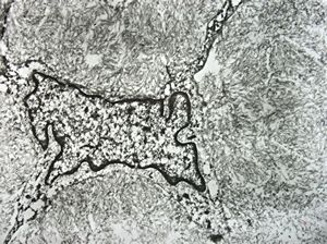 M,56y. | amyloidosis - tendon M,56y. | amyloidosis - tendon